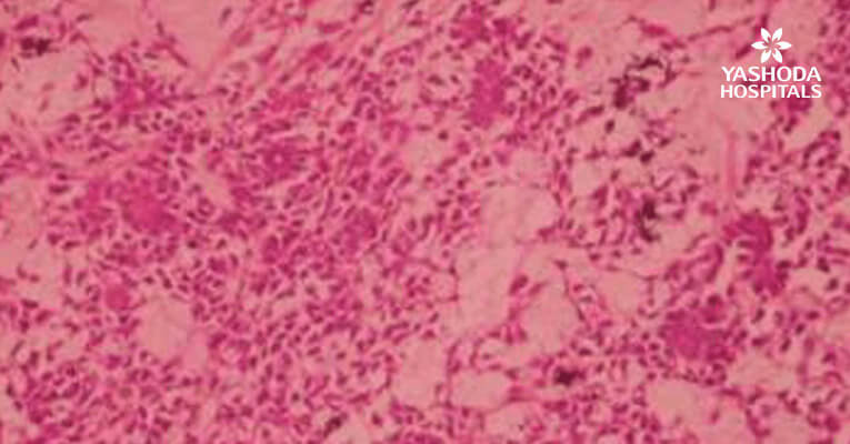Cutaneous Implantation Submandibular Pleomorphic Adenoma