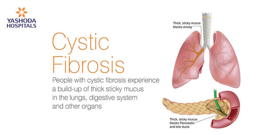 Cystic fibrosis-genetic disease