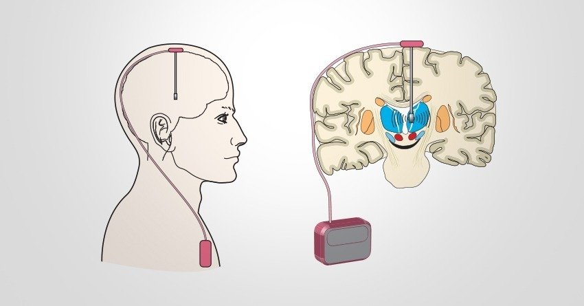 How To Treat Parkinsons Disease Using Deep Brain Stimulation 6685