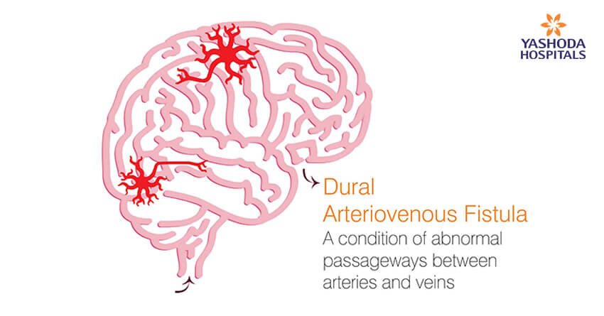 A condition of abnormal passageways between arteries and veins Dural arteriovenous fistulas (DAVF)