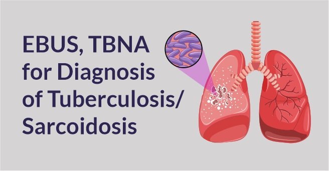 EBUS+TBNA for Diagnosis of Tuberculosis / Sarcoidosis