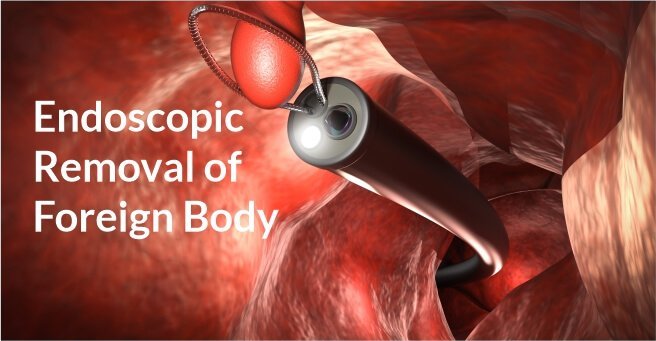 Endoscopic Removal of Foreign Body