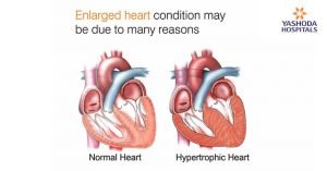 Enlarged Heart: Heart Enlargement Causes | Signs of Enlarged Heart