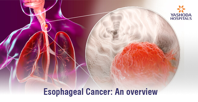 Esophageal Cancer: An overview