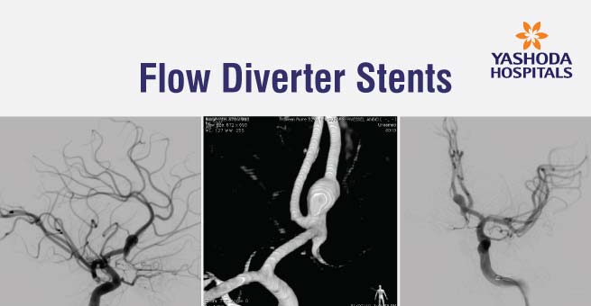 Flow Diverter Stents