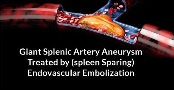 Giant Splenic Artery Aneurysm Treated By Spleen Sparing Endovascular