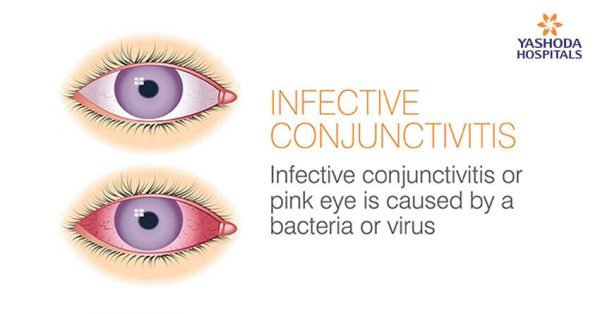 Infective Conjunctivitis Causes, Symptoms and Prevention ...