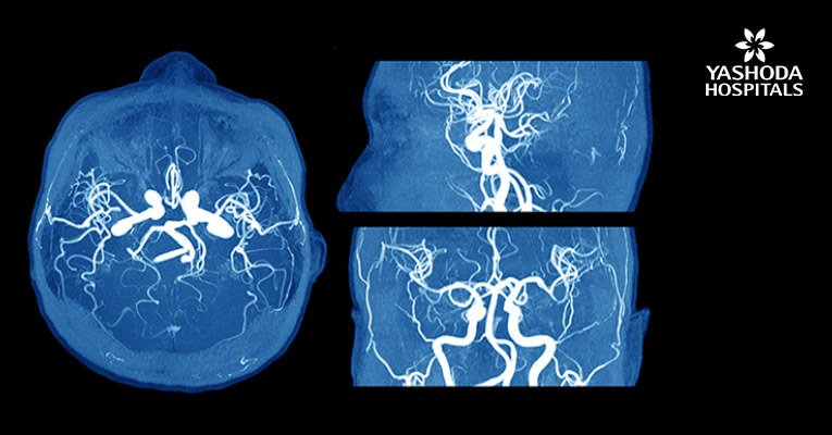 Intraoperative ICG Video Angiography in the Management of Intracranial Aneurysm Surgery