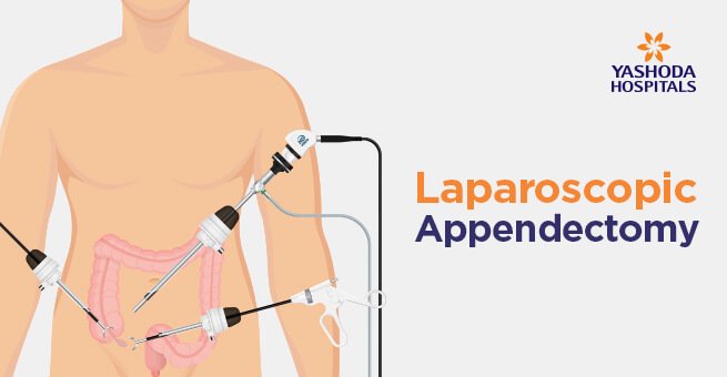 Laparoscopic Appendix Removal Surgery