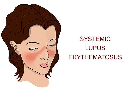 Lupus Speciality Clinic