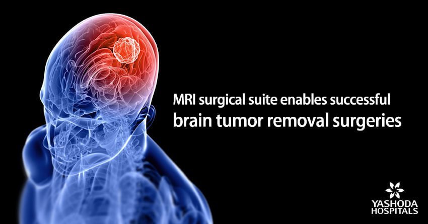 Intraoperative MRI (iMRI) for Brain Surgery in India.