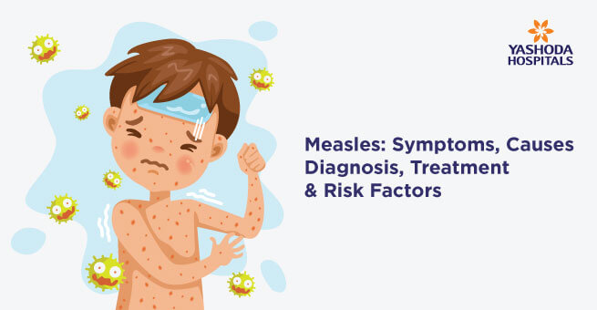 Measles Symptom Causes Diagnosis Treatment