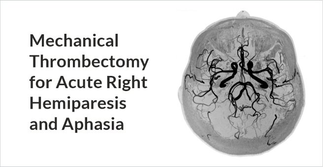 Mechanical Thrombectomy for Acute Right Hemiparesis and Aphasia