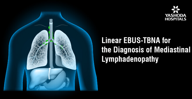 EBUS TBNA for the diagnosis of mediastinal lymphadenopathy