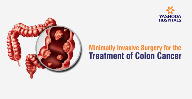 Minimally Invasive Surgery for the Treatment of Colon Cancer