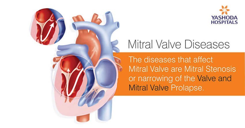 The diseases that affect mitral valve are mitral stenosis or narrowing of the valve and mitral valve prolapse