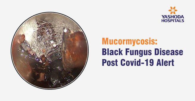 Mucormycosis Black Fungus Disease Post Covid 19