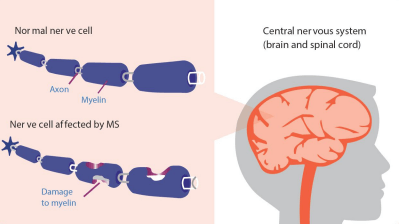 How MS interrupts nerve signals