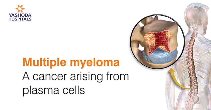 Multiple Myeloma. A cancer arising from plasma cells