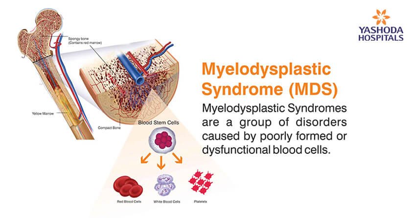 Myelodysplastic Syndrome is a condition where the bone marrow fails to produce proper number of blood cells (RBC, WBC and Platelets)