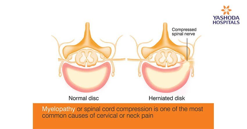 Myelopathy or spinal cord compression is one of the most common causes of cervical or neck pain