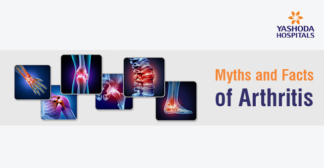 Myths and Facts of Arthritis