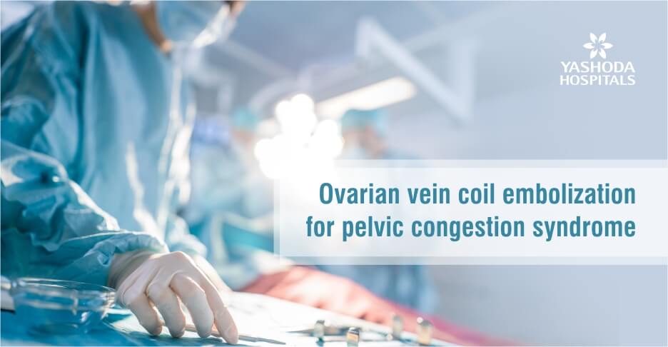 Ovarian vein coil embolization