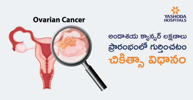 Ovarian Cancer symptoms
