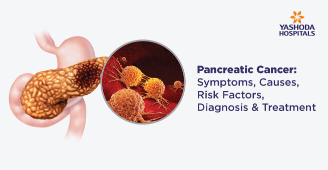Pancreatic Cancer Symptoms Causes Risk Factors Diagnosis Treatment