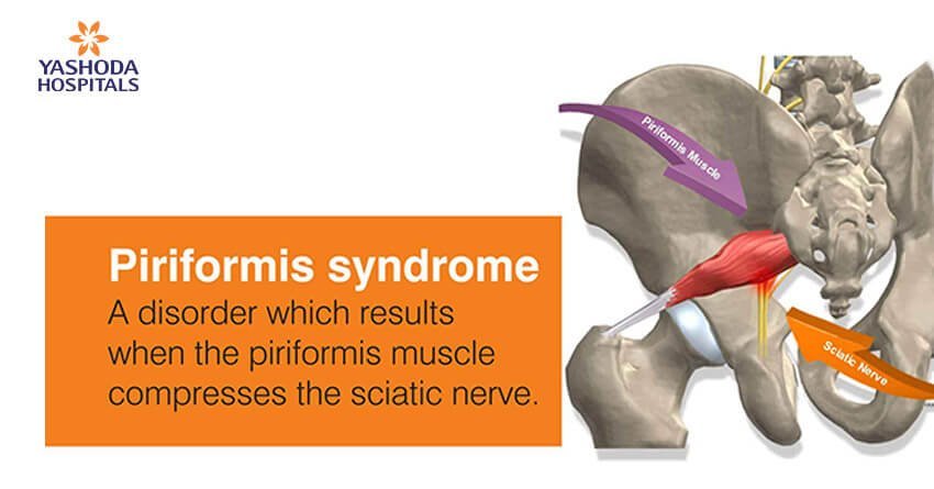 Piriformis Syndrome Treatment in Lekki - Piriformis Syndrome Treatment