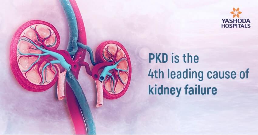 Polycystic Kidney Disease-kidney failure