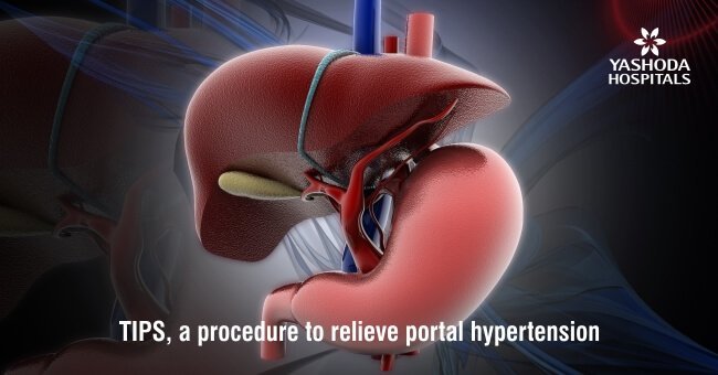 Portal hypertension and TIPS (Transjugular Intrahepatic Portosystemic Shunt)