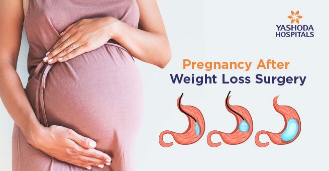 Pregnancy After Weight Loss Surgery