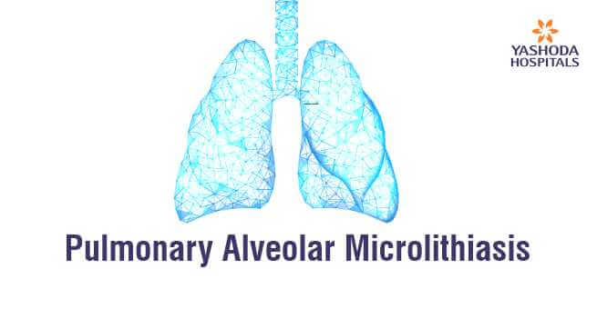 Pulmonary Alveolar Microlithiasis
