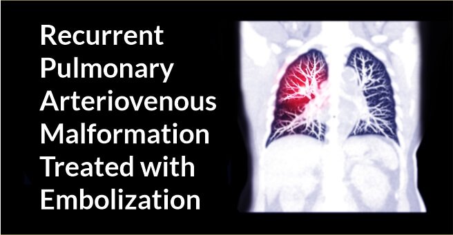 Recurrent Pulmonary Arteriovenous Malformation Treated withEmbolization