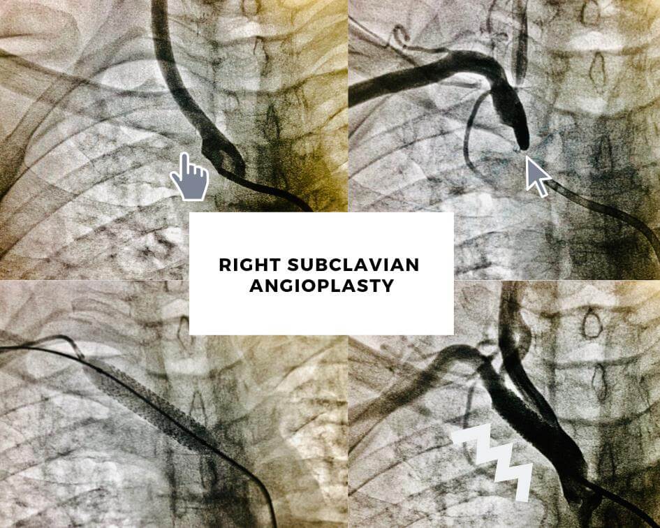 Right Subclavian Angioplasty