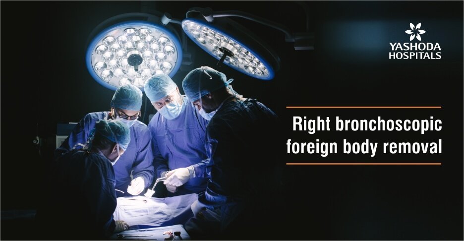 Right bronchoscopic foreign body removal