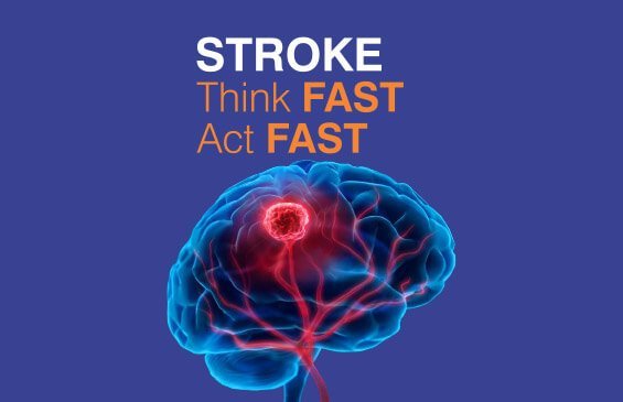 STROKE Think FAST Act FAST