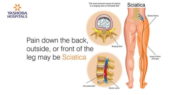 Common Causes of Sciatica - Orthopedic & Sports Medicine