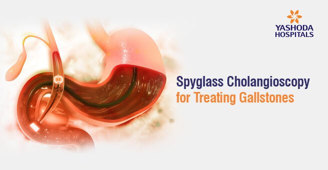 Spyglass cholongioscopy