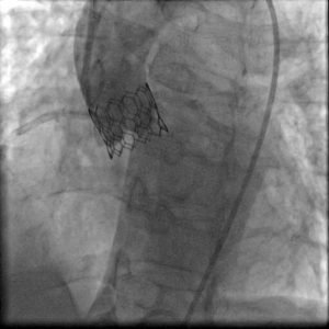 TAVR procedure for the management of severe aortic stenosis - Yashoda ...