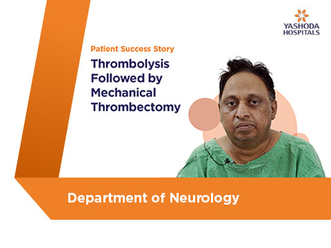 Thrombosis Followed by Mechanical Thrombectomy