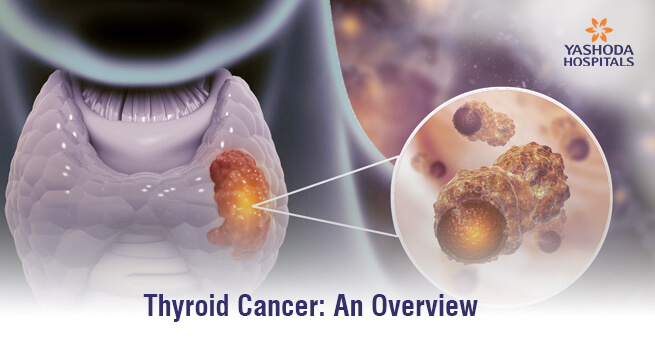 Thyroid Cancer: An Overview
