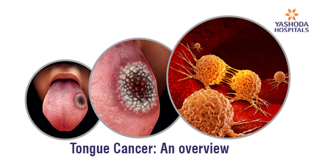 Tongue Cancer: An overview