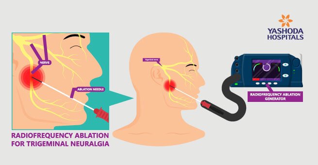 Radiofrequency Ablation for Trigeminal Neuralgia