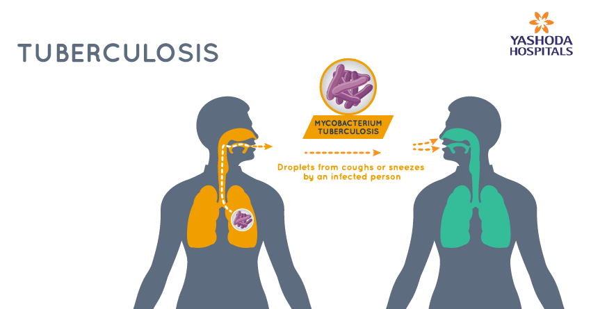 tuberculosis-tb-infectious-diseases-msd-manual-professional-edition