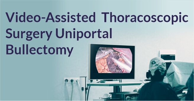 Video-Assisted Thoracoscopic Surgery of Solitary Fibrous Pleural TumorDr. BalasubramoniumMS (General Surgery), MCh(CVTS) Dr. Siva Prasad GoudMBBS, DNB (CVTS)Robotic & Minimally Invasive Thoracic Surgeon,Yashoda Hospitals, SecunderabadBACKGROUNDDIAGNOSIS & TREATMENTA 51 years old male patient came with a history of dyspnoea on exertion and purulent cough since 6 months. Pleural fluid aspiration was performed -6 times over 2 months. (1 - 1.5 litres of hemorrhagic pleural fluid was aspirated)Routine Investigations – WNLPFT:FVC – 1.26 FEV1 – 1.1 FEV1/FVC – 87.1ECHO – normal LV function , No RWMA Pre procedure chest radiographs showingmassive right pleural effusionCT scan showing solitary fibrous right pleural tumor CTscanshowedtwolargeheterogenouslyenhancing pleural based soft tissue density lesions with neovascularity in right hemithorax measuring 14.3x13.4x11.5cm and 7.9x7.5x6.1cm.Surgery - Pleural aspiration was done and 2 litres of fluid was drained. Patient developed hemodynamic instability and was resuscitated in OT. Right posterolateral thoracotomy was performed and the tumor was removed under VATS.Post op chest X rayRight pleural tumorVideo-Assisted Thoracoscopic Surgery Uniportal Bullectomy