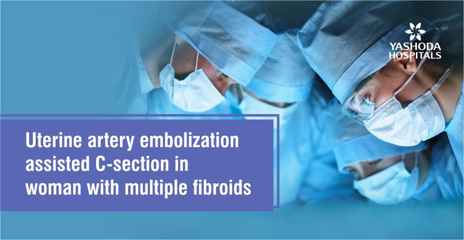 Uterine artery embolization assisted C-section in woman with multiple fibroids