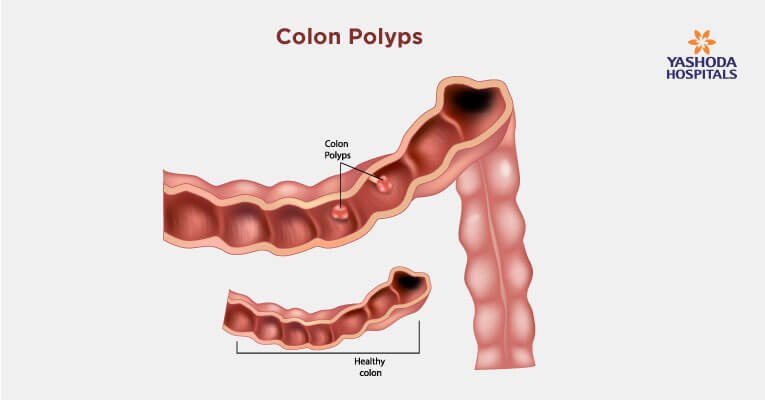 Colon Polyps Causes Symptoms Diagnosis And Treatment