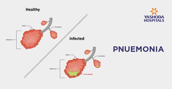 pneumonia virus symptoms